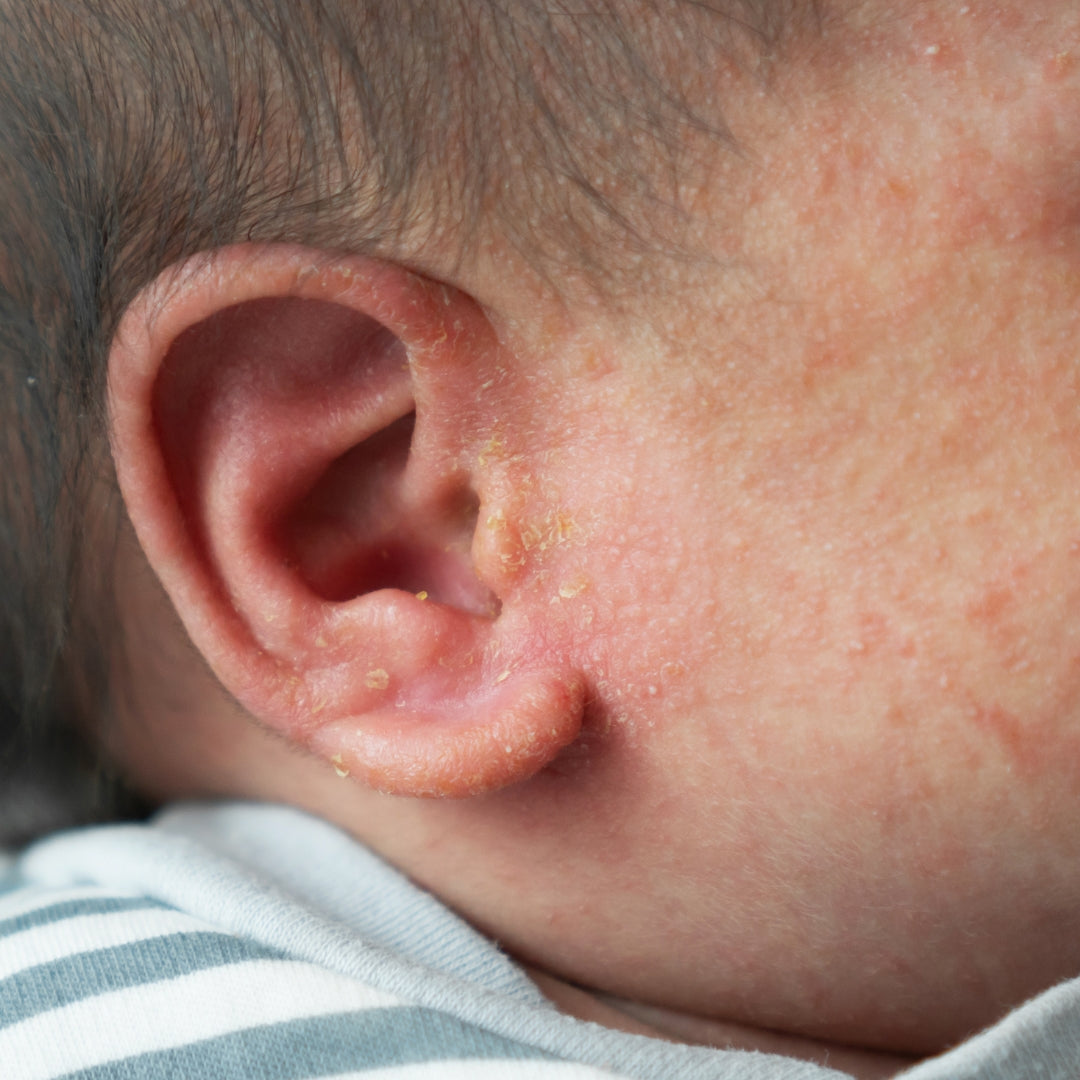 For Eczema/Damaged Skin