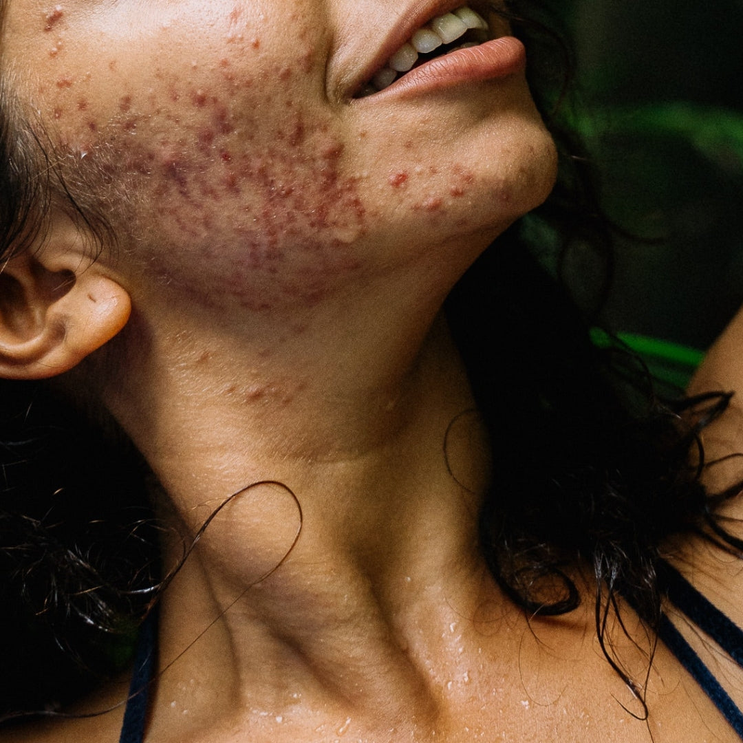 For Acne & Breakouts