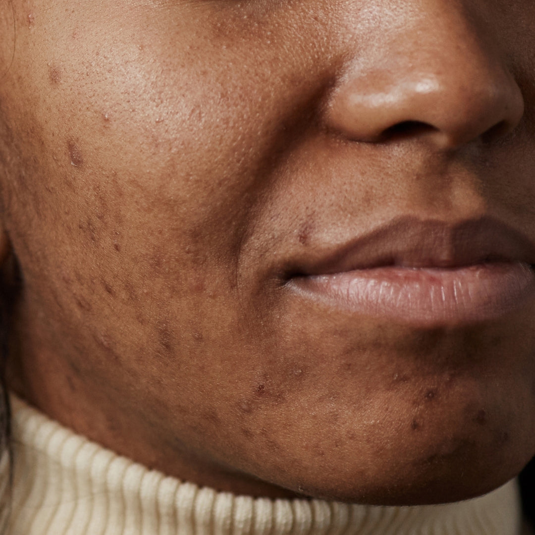 For Dark Spots & Hyperpigmentation